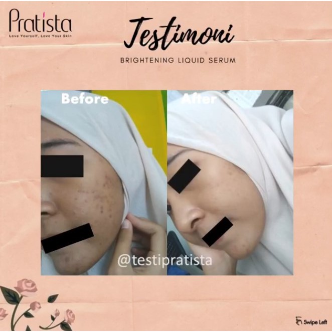 Pratista Brightening Liquid Serum Untuk Flek Kemerahan &amp; Bekas Jerawat