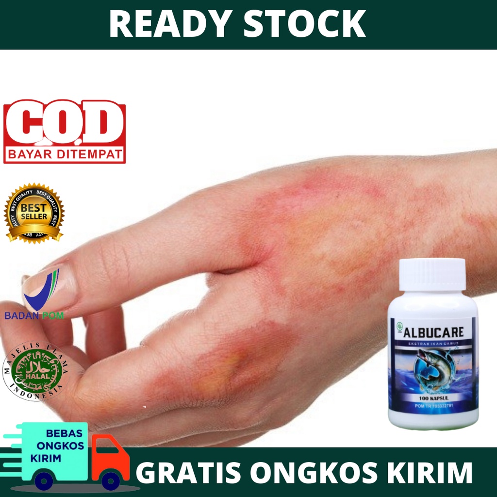 Obat Luka Bakar, Pengering Luka Bakar, Luka Bakar Bernanah, Luka Bakar Knalpot, Luka Diabetes