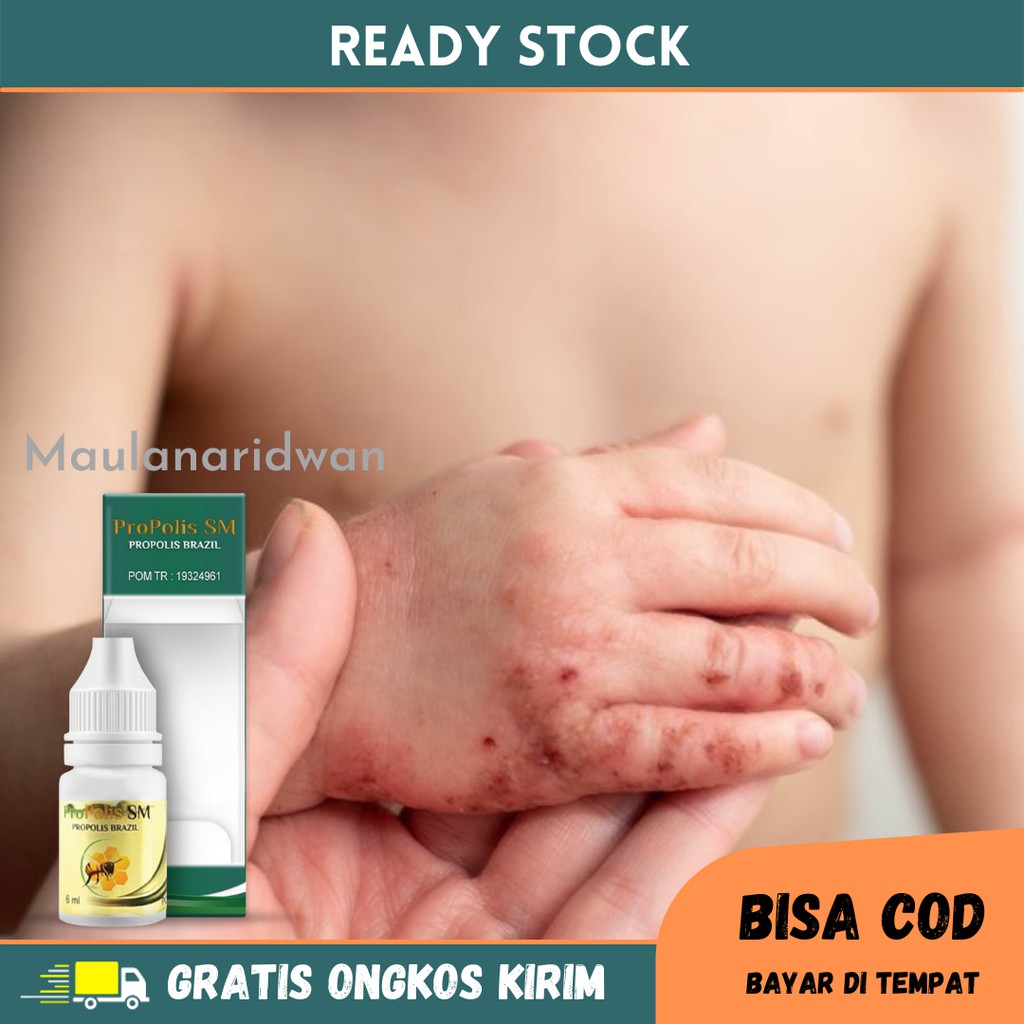 Obat Gatal Di Jari Tangan, Gatal Bernanah & Berair, Kutu Air Di Tangan,  Obat Herbal Gatal Di Tangan