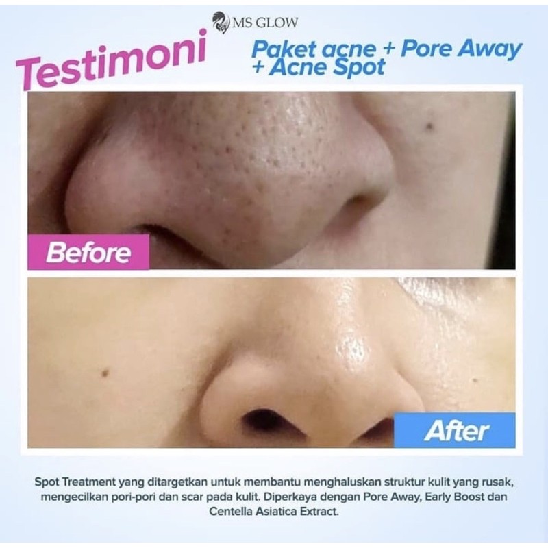 PORE AWAY TREATMENT MSGLOW