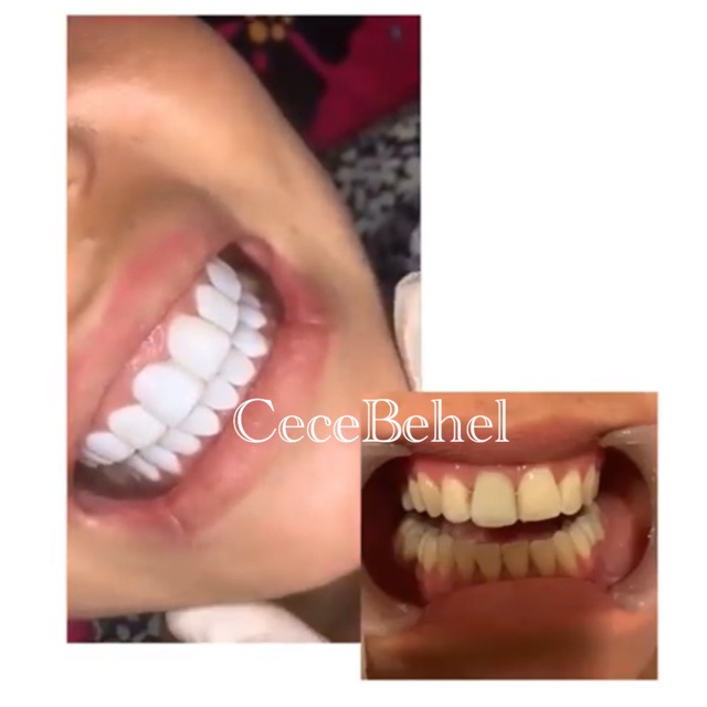 Veneer