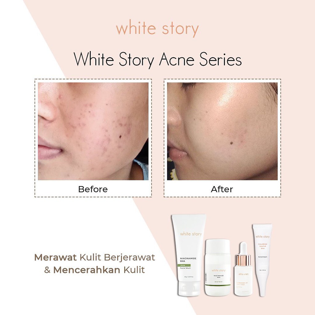 WHITE STORY ACNE SERIES  acne cream//facial wash//toner//soothing serum//