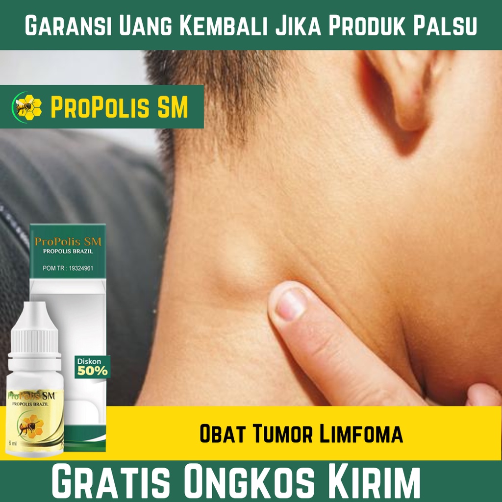 Obat Tumor Limfoma , Benjolan Di Leher , Pembengkakan Di Bawah Telinga , Kelenjar Limfoma | PROPOLIS