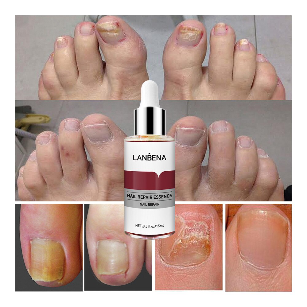 ORIGINAL Lanbena Kuku Perbaikan Essence Serum Jamur Perawatan Kuku