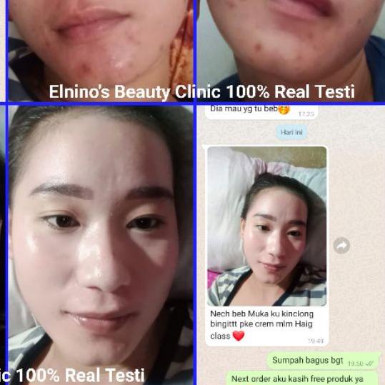 ♠ ELNINO'S ANTI-JERAWAT 125% PATEN RACIK BEAUTY CLINIC ✦