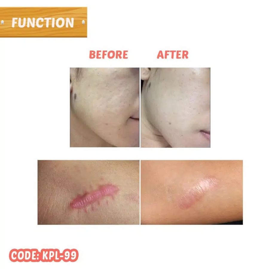 Bio Herbal Beauty Oil (Penghilang Bekas Luka) BPOM Original