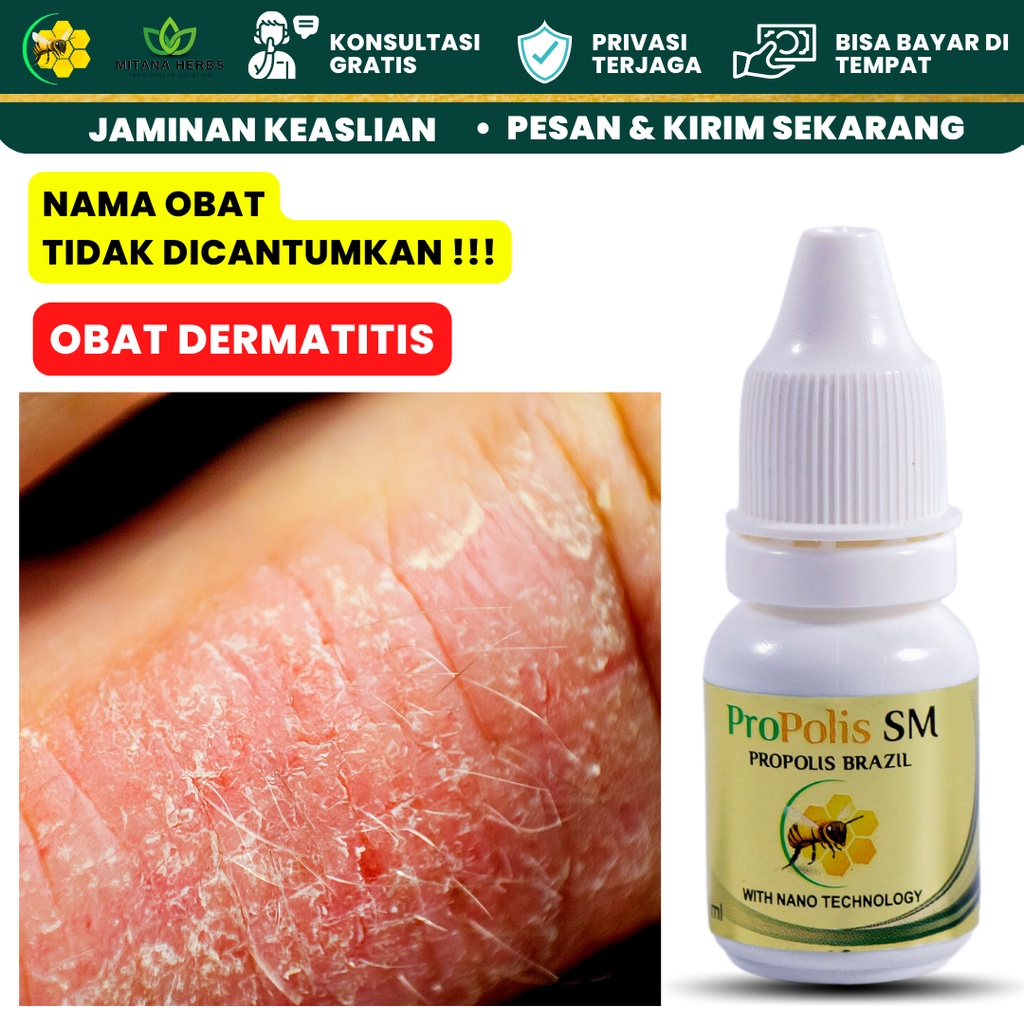 Mitana Herbal - Obat Dermatitis Seboroik - Obat Dermatitis Atopik - Obat Dermatitis Kontak - Obat De