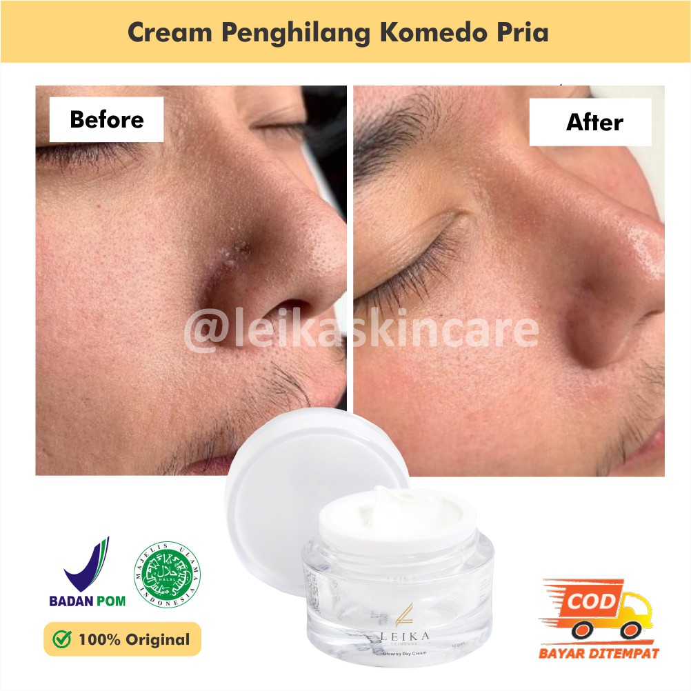 Cream Penghilang Komedo Bandel Penghilang Komedo Bpom Penghilang Komedo Hitam Ampuh Penghilang Komed