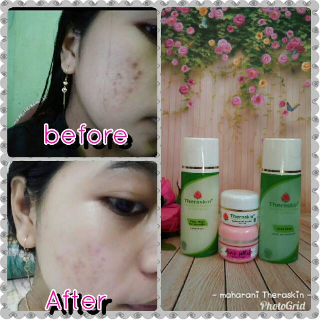 Jual Theraskin Acne White Glow Berjerawat Shopee Indonesia