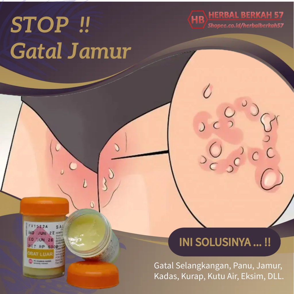 Salep Obat Gatal Eksim Kering Basah Menahun Paling Ampuh Kurap Kudis Selangkangan Jamur Kulit Gatel-7