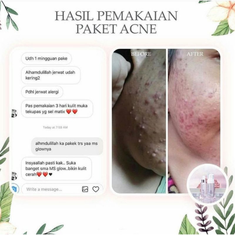 MS GLOW PAKET WHITENING LUMINOUS /PAKET MS GLOW ACNE SERIES / PAKET MS GLOW WHITENING/PAKET ULTIMATE