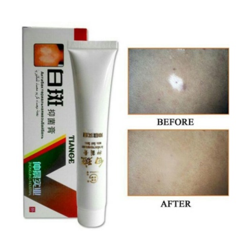 Obat Salep Vitiligo Salep Tiange Penghilang Bercah Putih 1000% Original