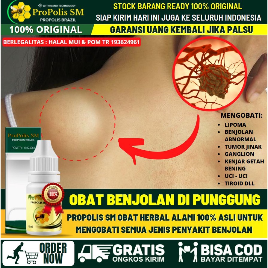 OBAT BENJOLAN DI PUNGGUNG, Penghancur Benjolan di Punggung, Obat Herbal Untuk Menghilangkan Benjolan
