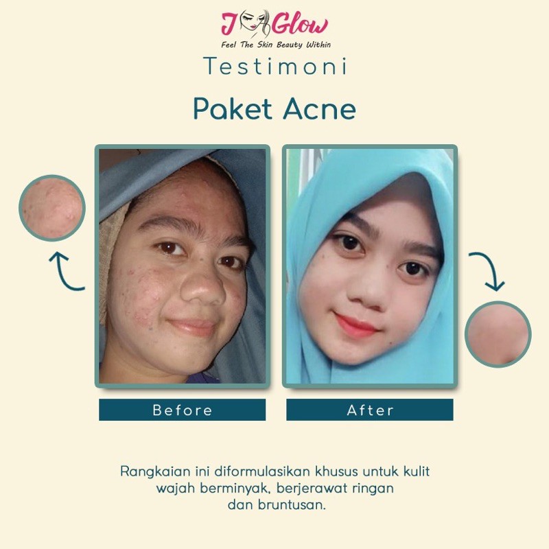 JGLOW SKINCARE ACNE + Acne Refine Serum