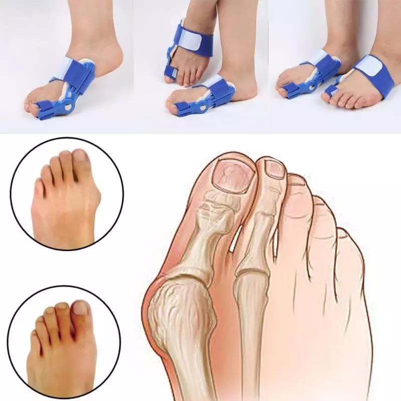 BUNION CORRECTOR SPLINT ALAT TERAPI KAKI BUNION HALLUX VALGUS TERAPI JARI KAKI BENGKOK INSOLE SEPATU