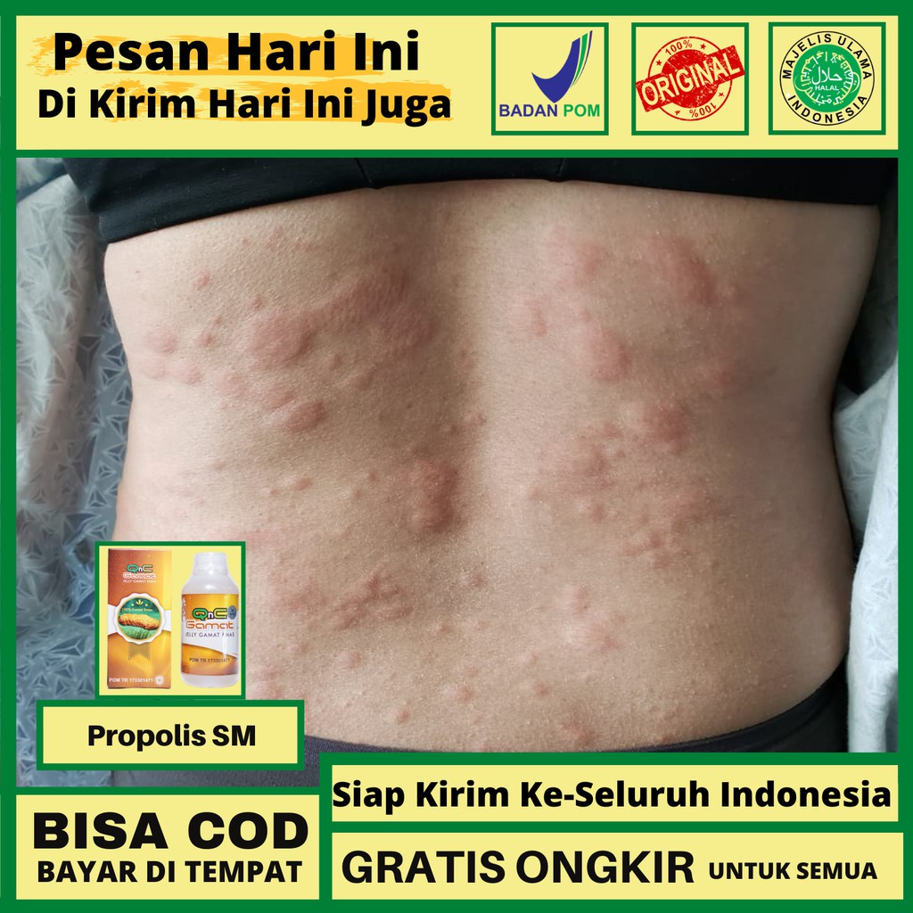 Obat Biduran Menahun / Alergi Kulit Gatal Herbal Qnc Jelly Gamat
