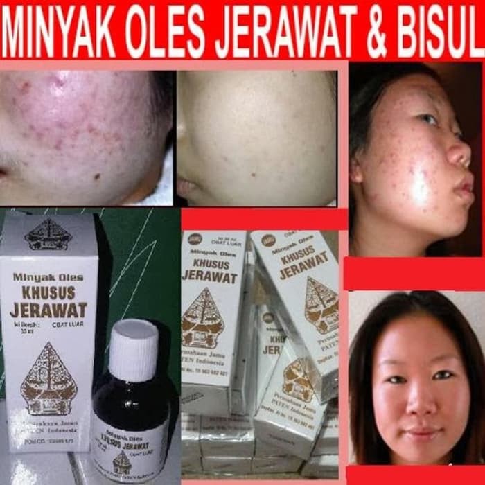 Minyak Oles Wayang Khusus Jerawat 30ml