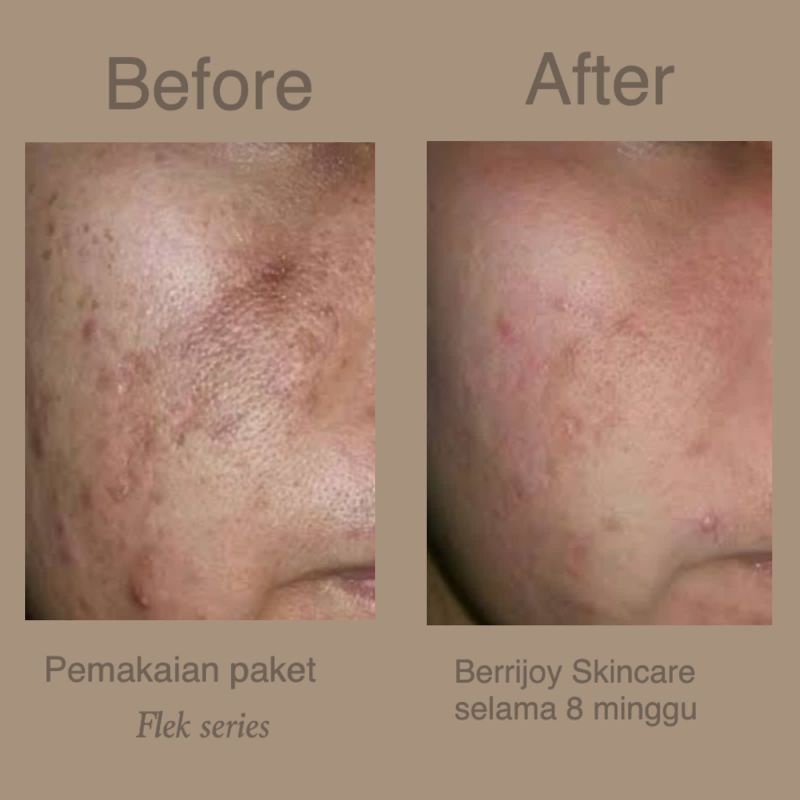 Paket Flek Berrijoy Skincare