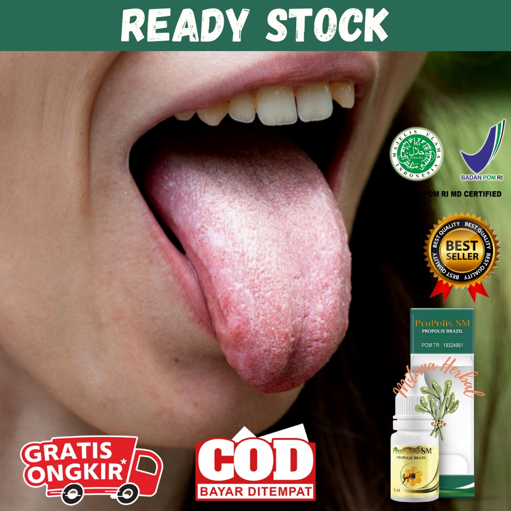 Obat Tetes Lidah Putih, Lidah Mati Rasa, Lidah Terasa Pahit, Lidah Pecah-Pecah Melepuh, Radang Lidah