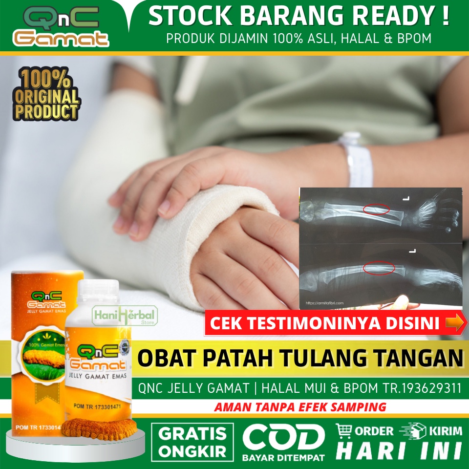 Obat Patah Tulang Tangan Untuk Anak & Dewasa, Obat Patah Pergelangan Tangan, Obat Patah Tulang Lenga