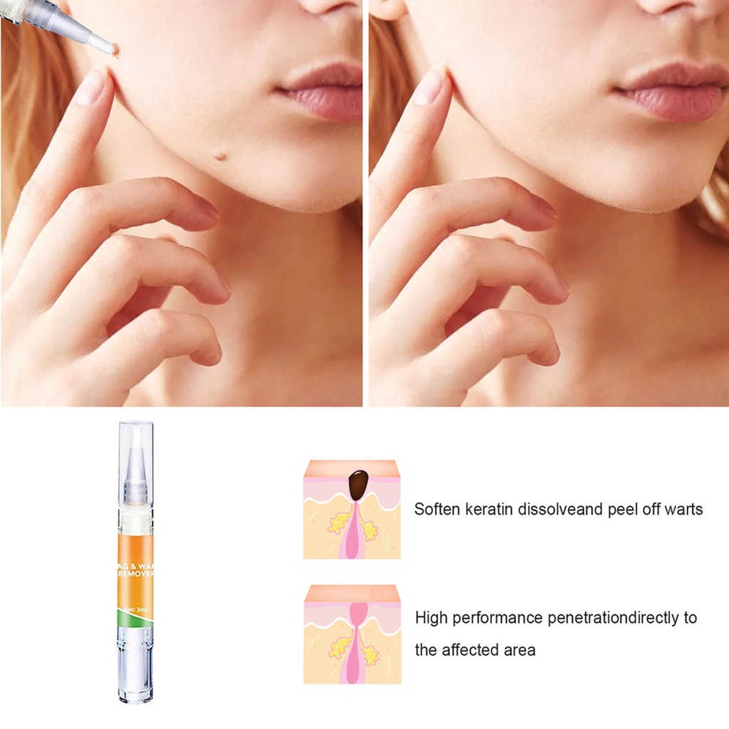 [100% Asli] Krim Obat Penghilang Kutil Badan Krim Penghilang Tanda Kulit Tahi Lalat