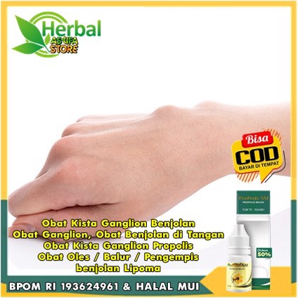 Obat Kista Ganglion Benjolan, Obat Ganglion, Obat Benjolan di Tangan, Obat Kista Ganglion Propolis, 