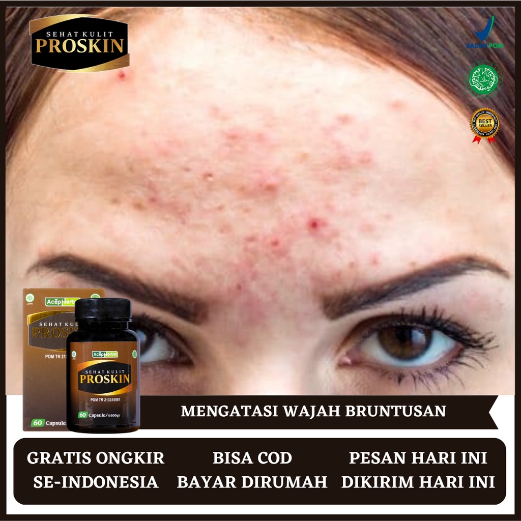 Obat Bruntusan, Obat Bruntusan Wajah, Obat Bruntusan di Jidat, Obat Bruntusan dan Jerawat, Obat Brun