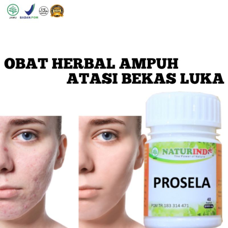 Obat Herbal Ampuh Atasi Bekas Luka Luka Bakar Luka parah