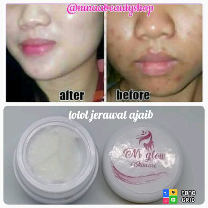 TOTOL JERAWAT AMPUH TOTOL ACNE NRGLOW DARK SPOT ACNE