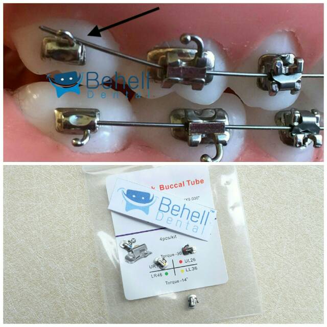 BUCCAL TUBE PENGUNCI BEHEL BRACKET KAWAT GIGI GERAHAM M1 M2 ROTH BUCAL - DENTAL ORTHO ORIGINAL