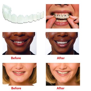 Snap On Instant Perfect Smile Perapi Gigi Senyum Pepsodent Snap On Instant Perfect Smile Perapi Gigi Senyum Pepsodent