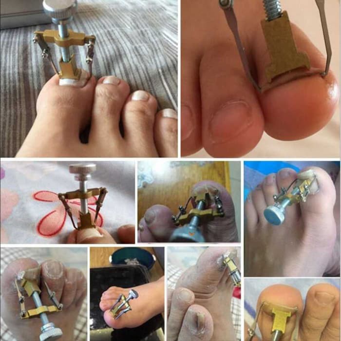 Alat Korektor Jempol Kuku Kaki Ingrown Nail Care -BS12