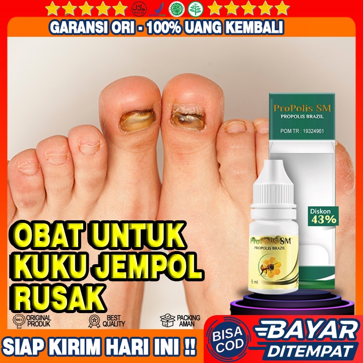 Obat Kuku Jempol Rusak - Kuku Kaki Jamur dan Rusak - Kuku Kaki Cantengan - Kuku Kaki Bau