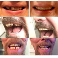 Instant Smile Temporary Tooth Kit Replace A Missing Tooth In Minutes