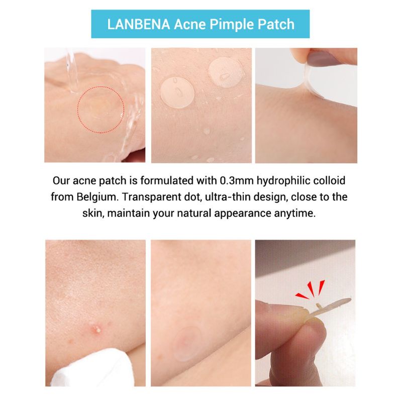 Lanbena Acne Pimple Patch Day &amp; Night Striker Jerawat / Stiker Jerawat / Penutup Jerawat / Plester Jerawat