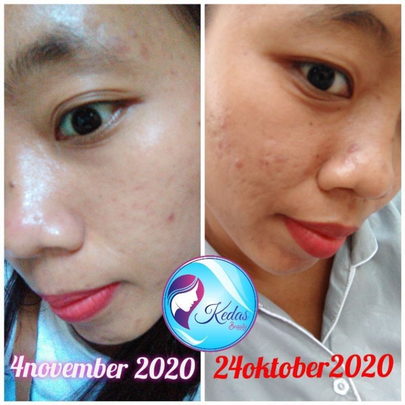 [BISA COD] SABUN KEDAS BEAUTY ORIGINAL BPOM | Kedas Beauty | Sabun Pemutih Wajah-4