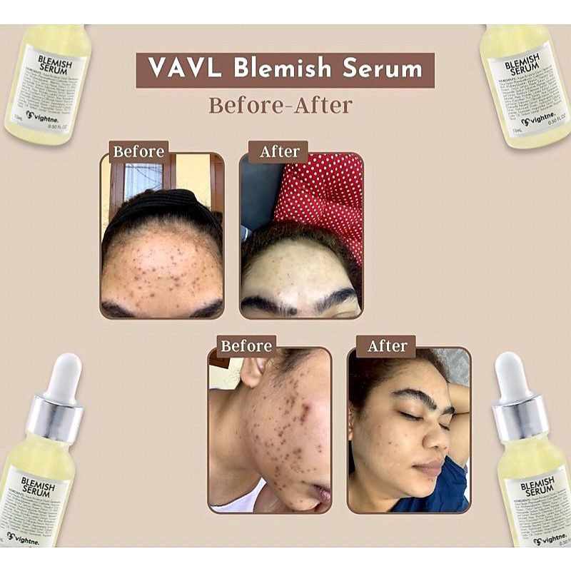 VAVL BLEMISH SERUM VIGHTNE [𝗕𝗣𝗢𝗠]