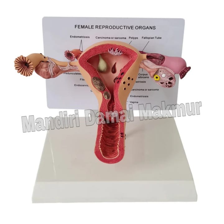 Alat Peraga/Alat Pengajaran Anatomical Model of Human Female Uterus Ovary Disease