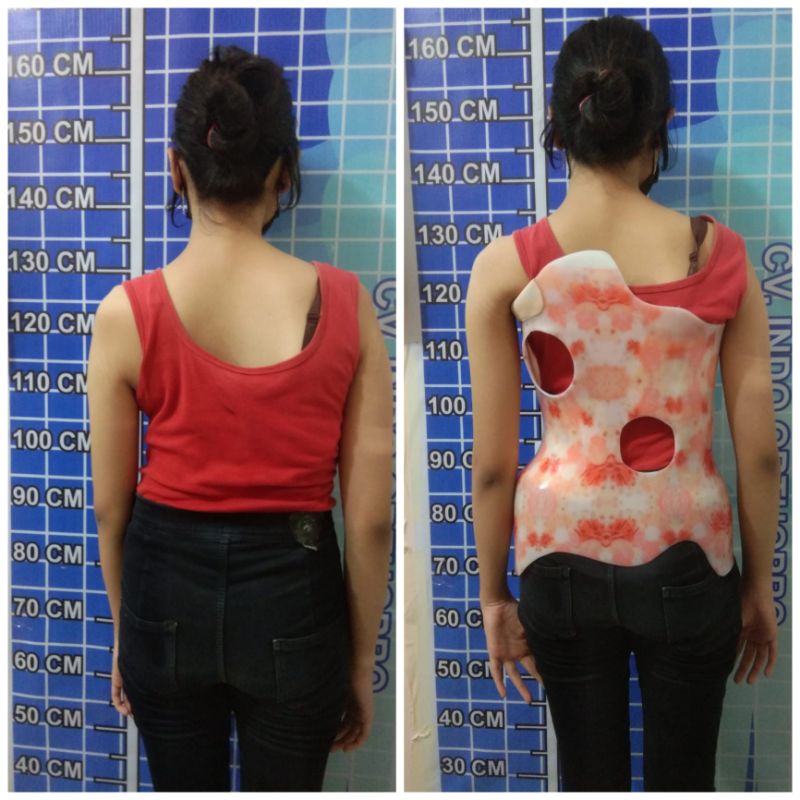 Skoliosis Brace / Scoliosis / Skoliosis / tulang belakang bengkok