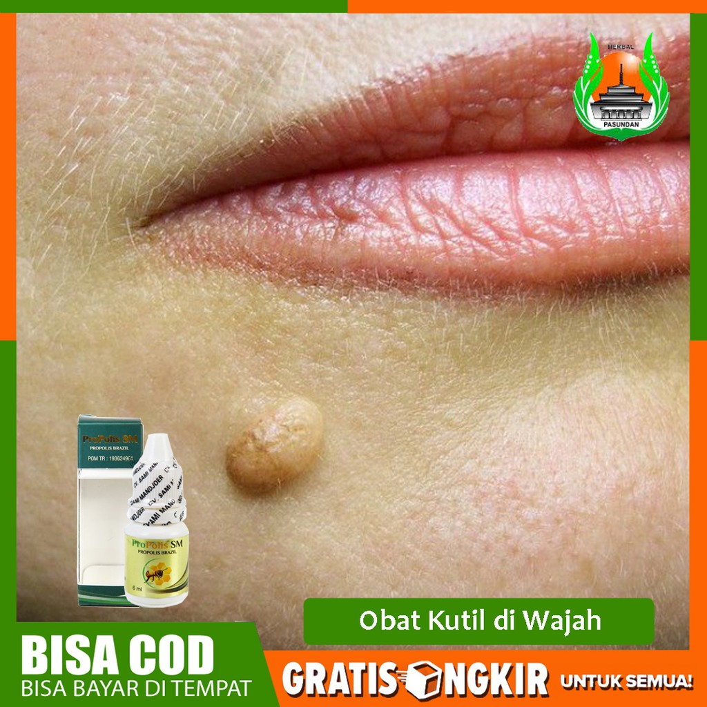 Obat Kutil di Wajah, Kutil Filiform Herbal Alami Propolis SM Original - Bisa COD - HALAL Legal BPOM