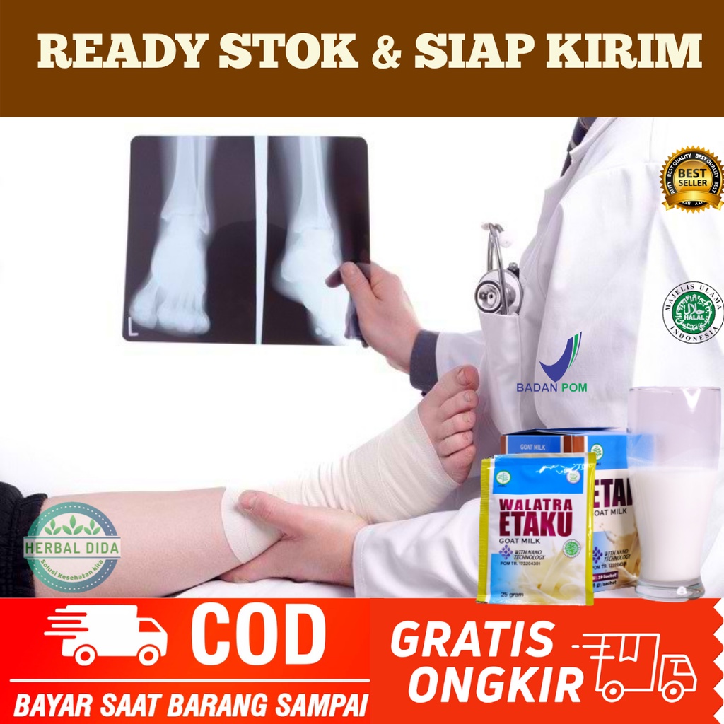 OBAT PATAH TULANG DEWASA, Susu Sembuhkan Patah Tulang, OBAT PATAH TULANG RETAK, Susu Penambah Kalsiu