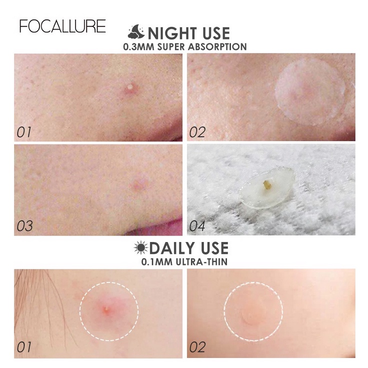 FOCALLURE (day / night) acne patch obat jerawat sticker mengatasi jerawat batu biji beruntusan bruntusan murah bpom pagi malam tipis tidak tebal