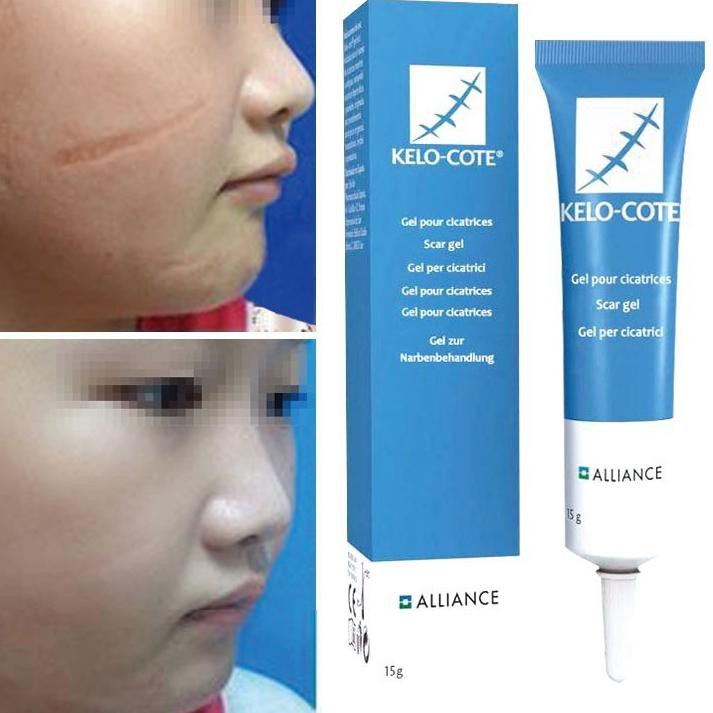 Bestseller IHH Kelo Cote Cream Obat Penghilang Bekas Luka Jahitan Keloid Ampuh Original Import surgi