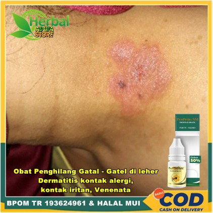 Obat Penghilang Gatal - Gatel di leher | Salep Oles Dermatitis kontak alergi, Dermatitis kontak irit