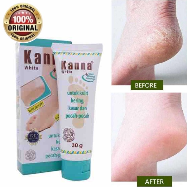 Kanna Krim Kaki | Kanna White | Kanna Krim Lembut 15gr/30gr (Krim Kulit Kering Kasar Pecah2)