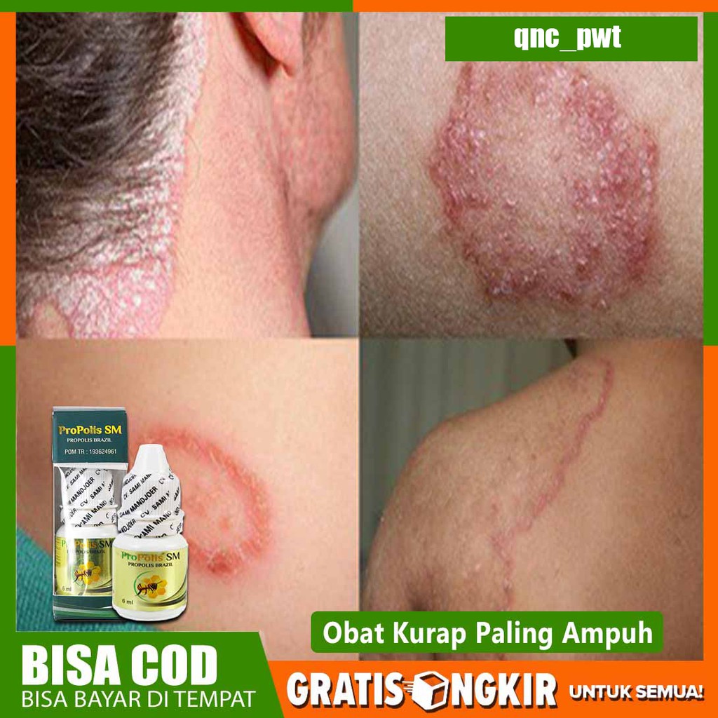 Obat Kurap - Penghilang Panu - Eksim - Kudis - Panu Menahun - Kutu Air Propolis SM Brazil 100% Asli
