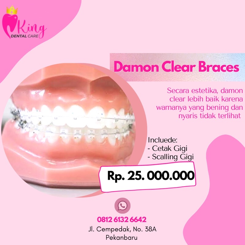 Jual Perawatan Damon Clear Braces Shopee Indonesia