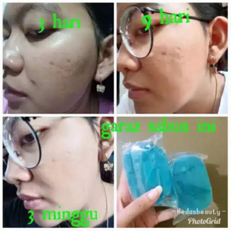 KEDAS BEAUTY SABUN KEDAS / BRIGHTENING SOAP / SABUN PEMUTIH 100G-1