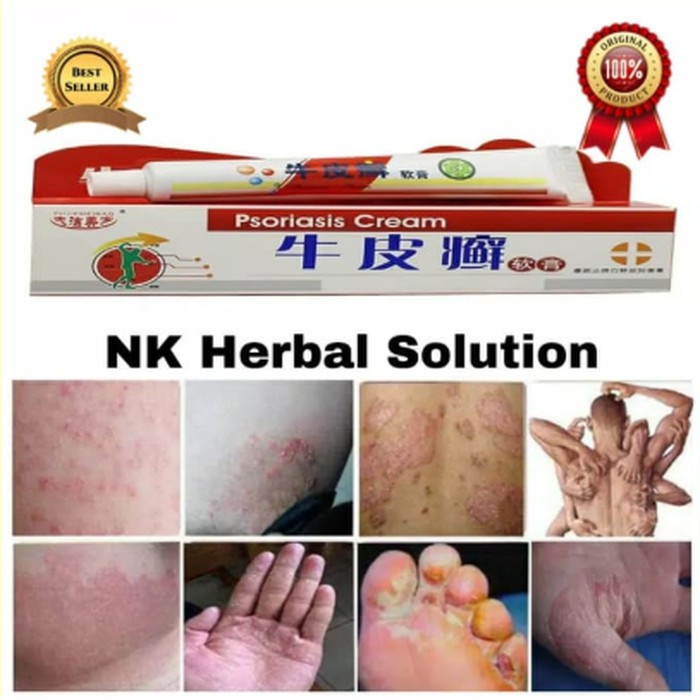 ACC-H103 PSORIASIS Cream Cina Ampuh Mengatasi Exim dan Macam Penyakit Kulit
