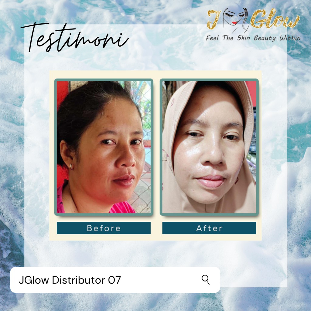 JGLOW Flek Melasma Hyperpigmentasi | Paket Perawatan Wajah Skincare BPOM-6